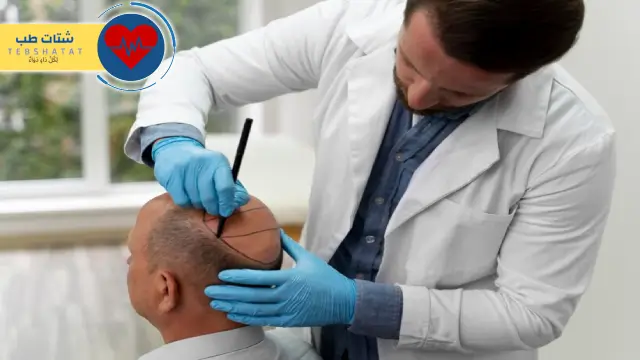 تكلفة زراعة الشعر في السعودية