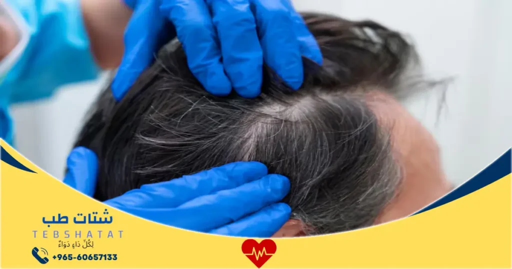 تجربتي مع زراعة الشعر في ادمه