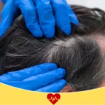 تجربتي مع زراعة الشعر في ادمه