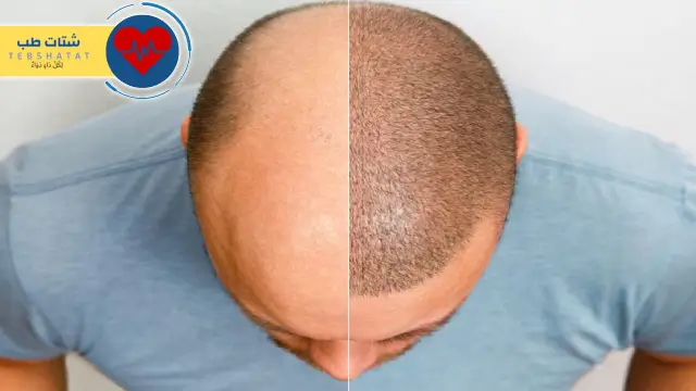 تكلفة زراعة الشعر في الرياض