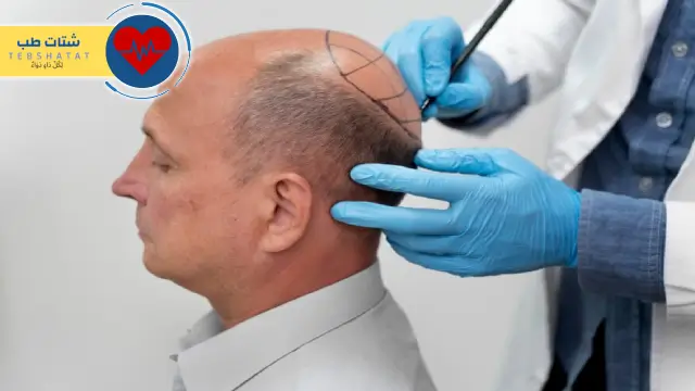 تكلفة زراعة الشعر في الرياض