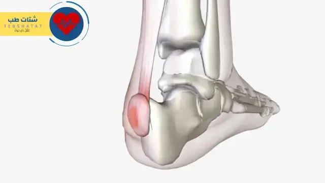 أفضل دكتور لعلاج التهاب اللفافة الأخمصية