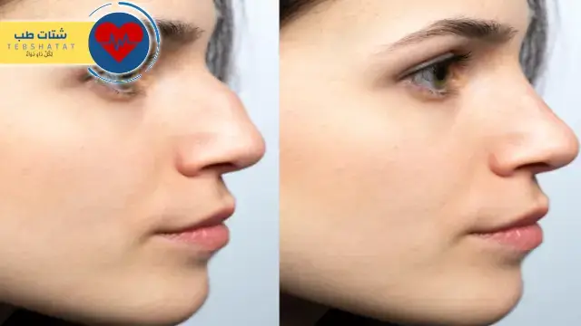 أسعار عمليات تجميل الأنف في مستشفى دلة 3 أسعار عمليات تجميل الأنف في مستشفى دلة