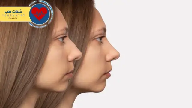 أسعار عمليات تجميل الأنف في مستشفى دلة 6 أسعار عمليات تجميل الأنف في مستشفى دلة