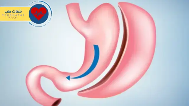تكلفة عملية التكميم الدكتور عائض القحطاني