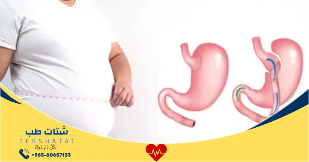 تكلفة عملية التكميم الدكتور عائض القحطاني