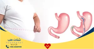 كم تكلفة عملية التكميم الدكتور عائض القحطاني؟