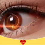 سعر عملية تصحيح النظر في الحبيب