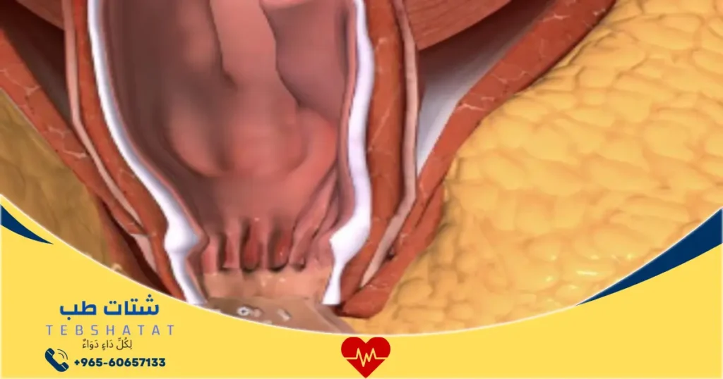 تجربتي مع عملية الشرخ بالليزر