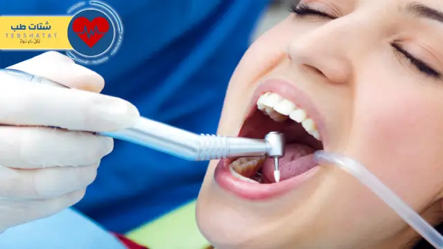 كم سعر تنظيف الاسنان من الجير كم سعر تنظيف الاسنان من الجير